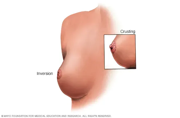 نوع پاژه پستان (Paget's disease of the breast)