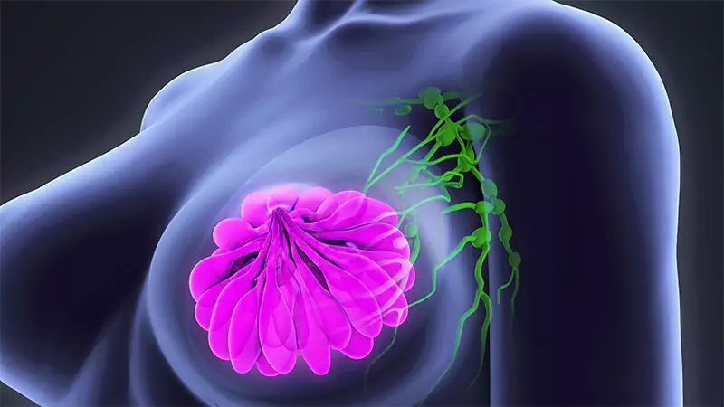 علائم سرطان پستان کدامند
