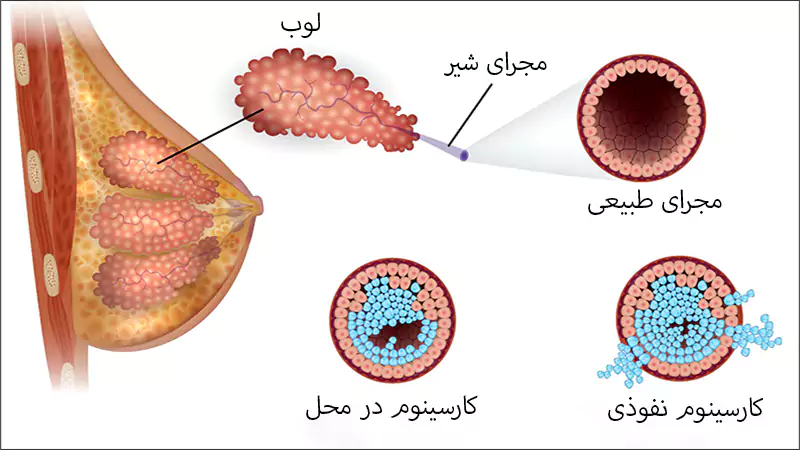 سرطان سینه چگونه ایجاد می شود