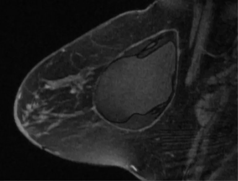 تصویربرداری رزونانس مغناطیسی (MRI) ایمپلنت نسل دوم با پارگی داخل کپسولی، مایع سیلیکونی آزاد درون کپسول وجود دارد.