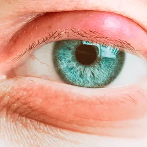 درمان کیست پلک چشم