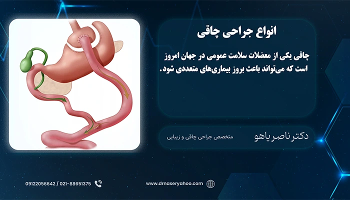 انواع جراحی چاقی