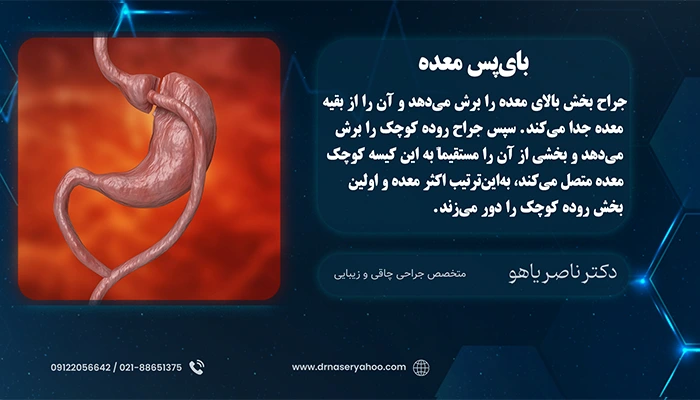 بای‌ پس معده