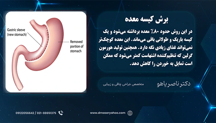 برش کیسه معده