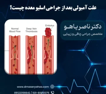 علت آمبولی بعد از جراحی اسلیو معده چیست؟