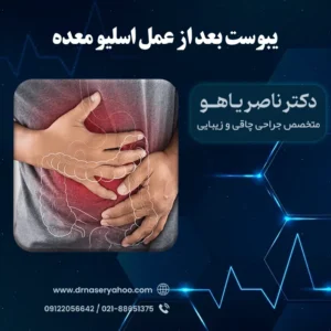 یبوست بعد از عمل اسلیو معده