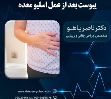 یبوست بعد از اسلیو معده