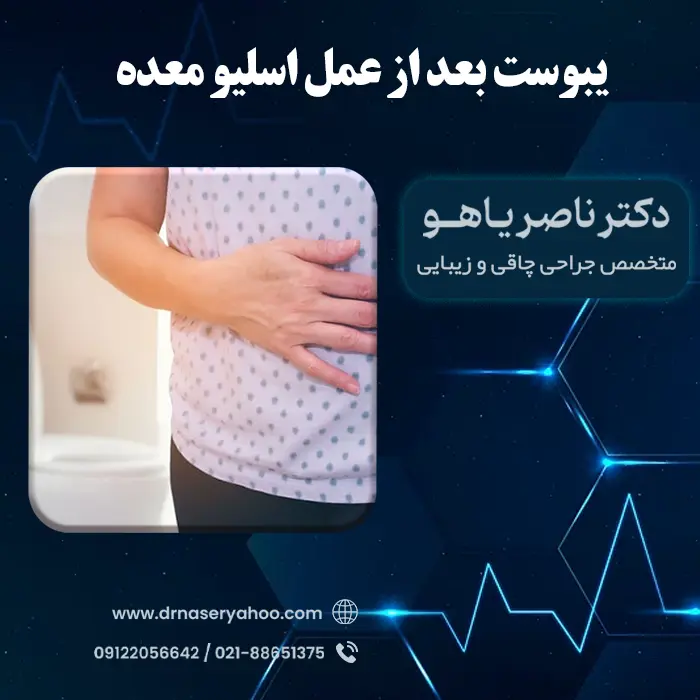 یبوست بعد از اسلیو معده