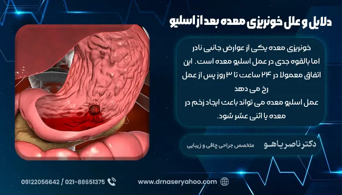 دلایل و علل خونریزی معده بعد از اسلیو