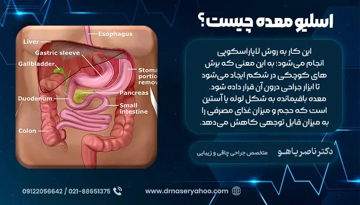 اسلیو معده چیست؟