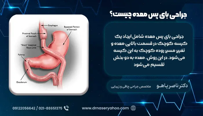 جراحی بای پس معده چیست؟
