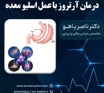 درمان آرتروز با عمل اسلیو معده