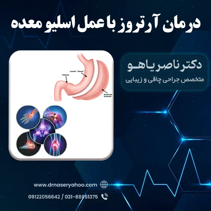 درمان آرتروز با عمل اسلیو معده