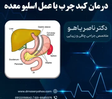 درمان کبد چرب با عمل اسلیو معده