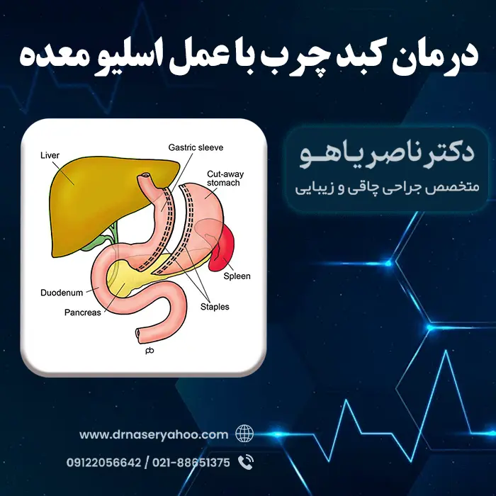 درمان کبد چرب با عمل اسلیو معده