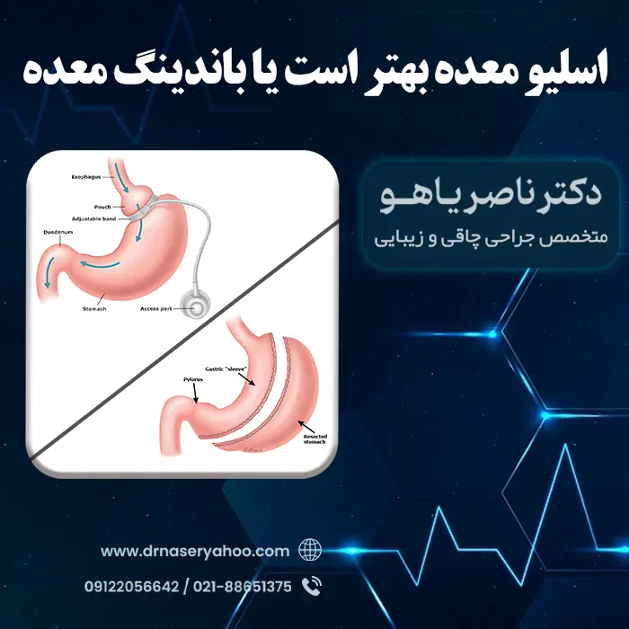 اسلیو معده بهتر است یا باندینگ معده