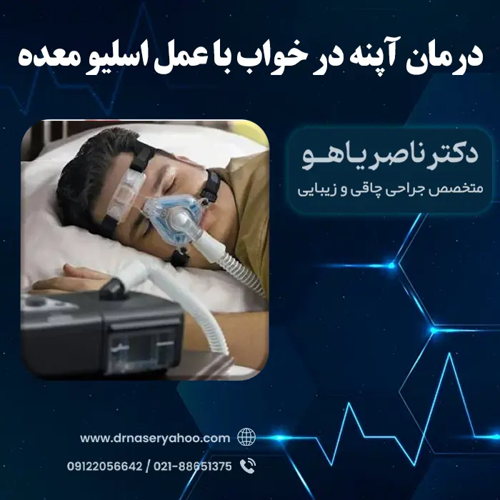 درمان آپنه در خواب با عمل اسلیو معده