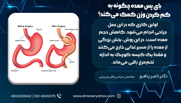 درمان آرتروز با عمل بای پس معده ، بای پس معده چگونه به کم کردن وزن کمک می‌کند؟