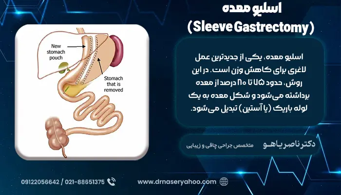 اسلیو معده (Sleeve Gastrectomy)