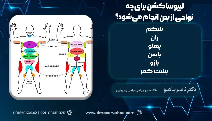 لیپوساکشن برای چه نواحی از بدن انجام می‌شود؟