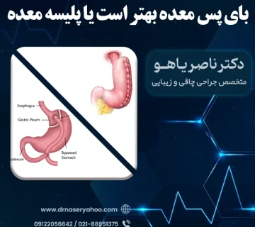 بای پس معده بهتر است یا پلیسه معده