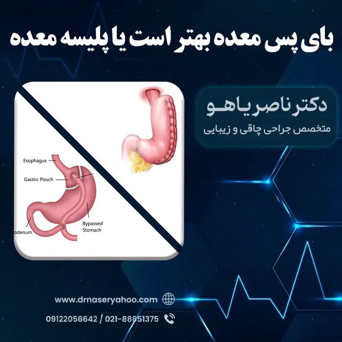 بای پس معده بهتر است یا پلیسه معده