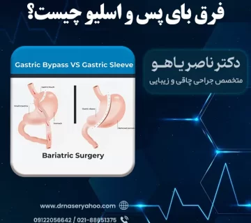 فرق اسلیو و بای پس چیست؟
