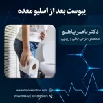یبوست بعد از اسلیو معده