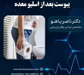 یبوست بعد از اسلیو معده
