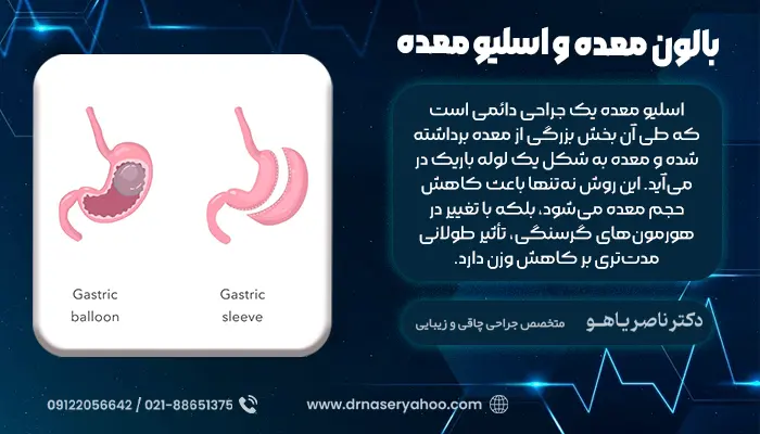 بالون معده و اسلیو معده