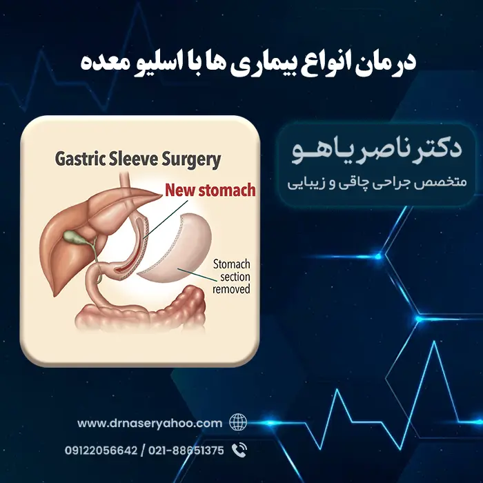 درمان بیماری‌ ها با اسلیو معده