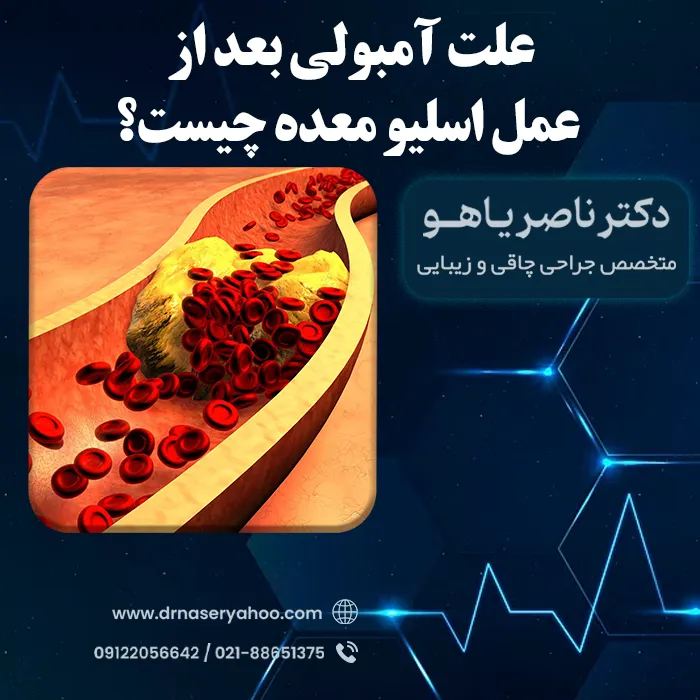 علائم آمبولی بعد از عمل اسلیو معده چیست؟