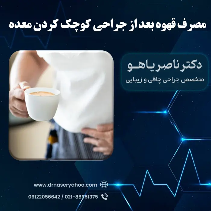 خوردن قهوه بعد از عمل جراحی اسلیو معده