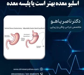 اسلیو بهتر است یا پلیسه معده