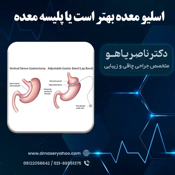 اسلیو بهتر است یا پلیسه معده