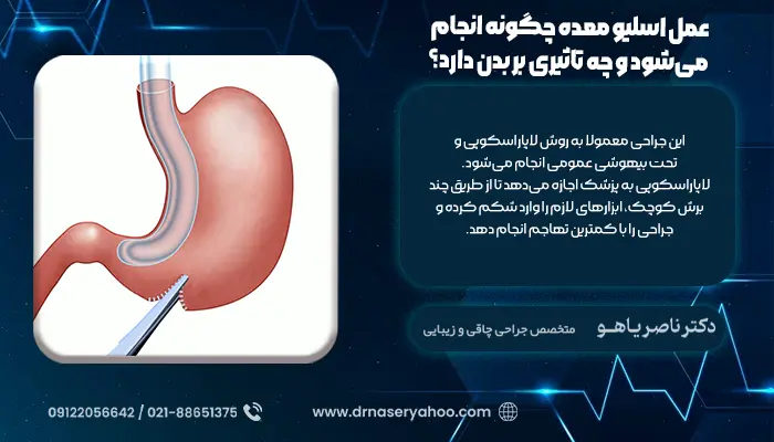 عمل اسلیو معده چگونه انجام می‌شود و چه تاثیری بر بدن دارد؟