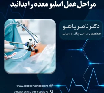 مراحل عمل اسلیو معده را بدانید