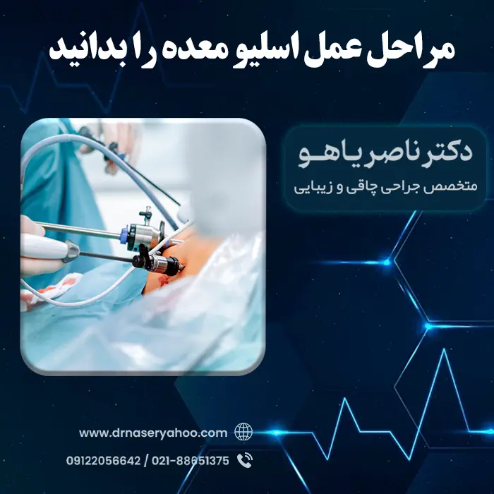 مراحل عمل اسلیو معده را بدانید