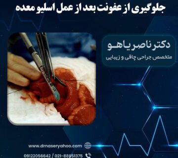جلوگیری از عفونت بعد از عمل اسلیو معده