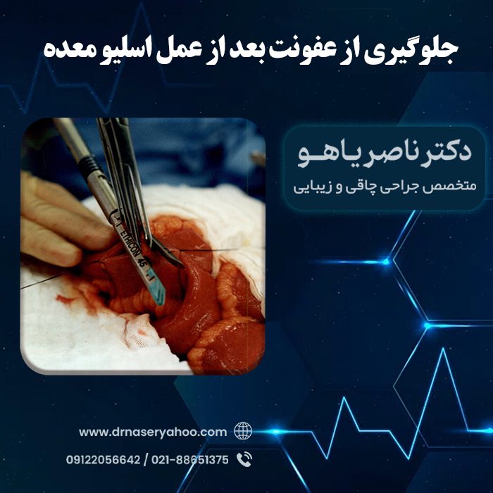 جلوگیری از عفونت بعد از عمل اسلیو معده