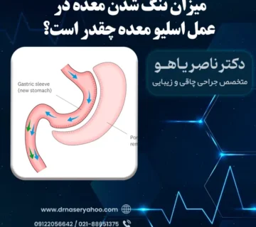 میزان تنگ شدن معده در عمل اسلیو معده چقدر است؟