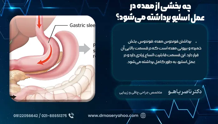 چه بخشی از معده در عمل اسلیو برداشته می‌شود؟