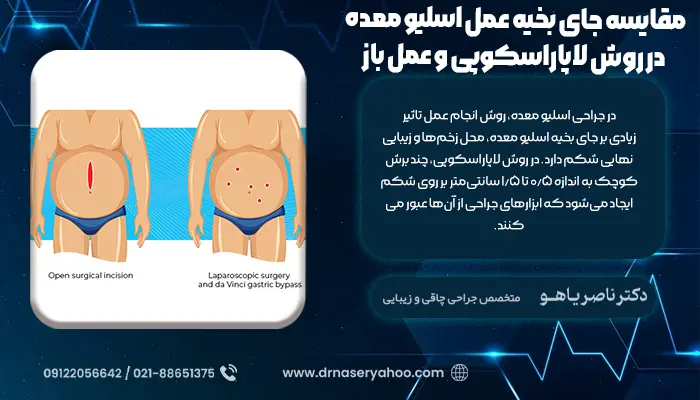 مقایسه جای بخیه عمل اسلیو معده در روش لاپاراسکوپی و عمل باز